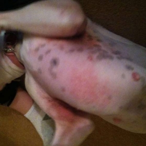 Skin irritation